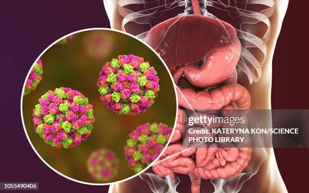 Preventing Severe Norovirus