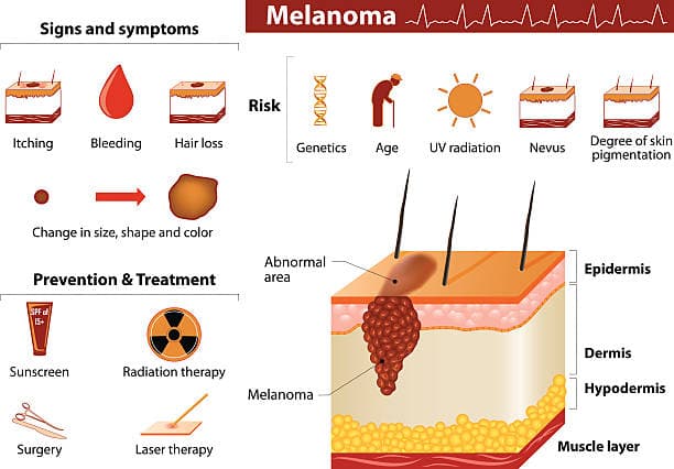 Illustration of skin cancer symptoms including abnormal moles and skin changes
