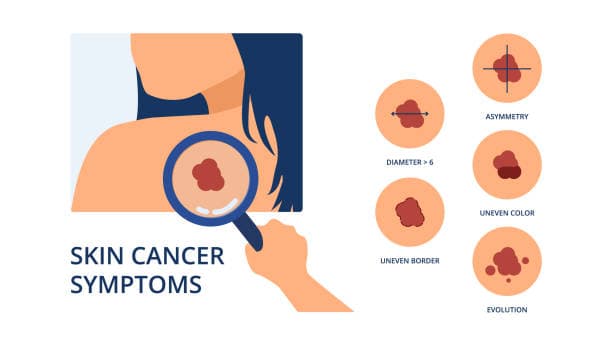 Symptoms of skin cancer visual guide