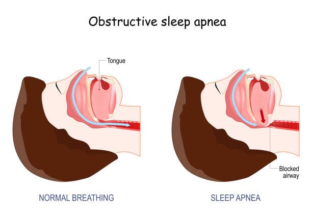 Risk Factors for Sleep Apnea and Snoring
