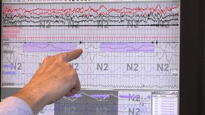 Sleep Study Results