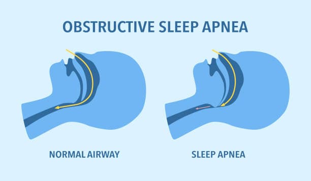 Infographic on sleep apnea risk factors including obesity and age