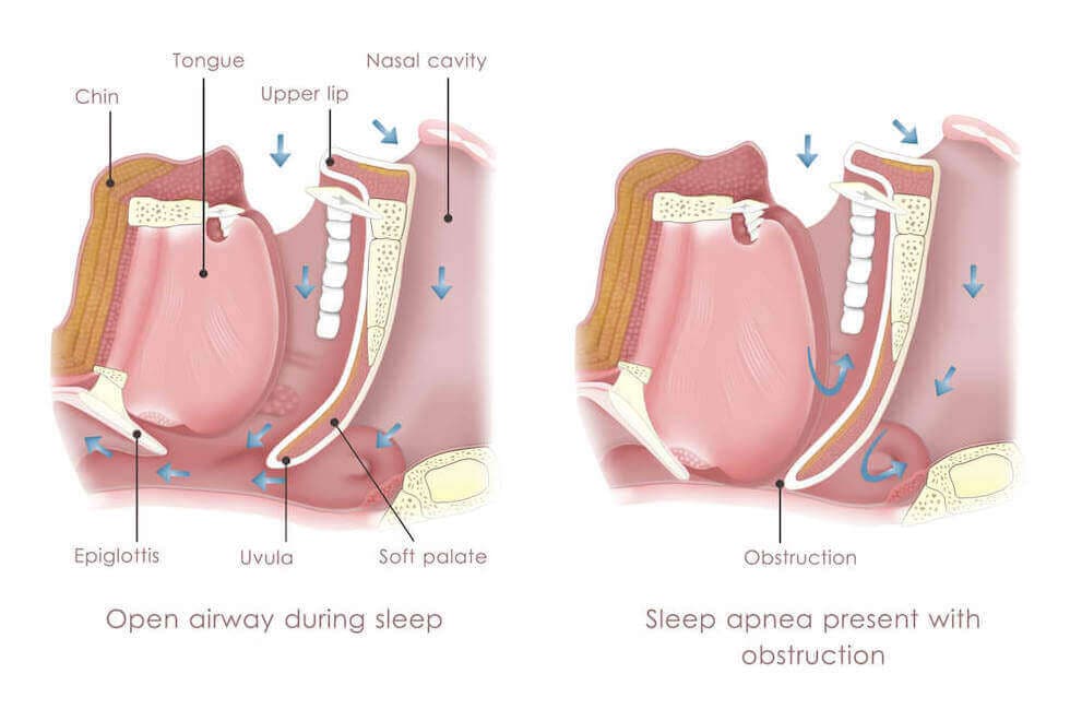 Sleep Apnea Treatment Diagram