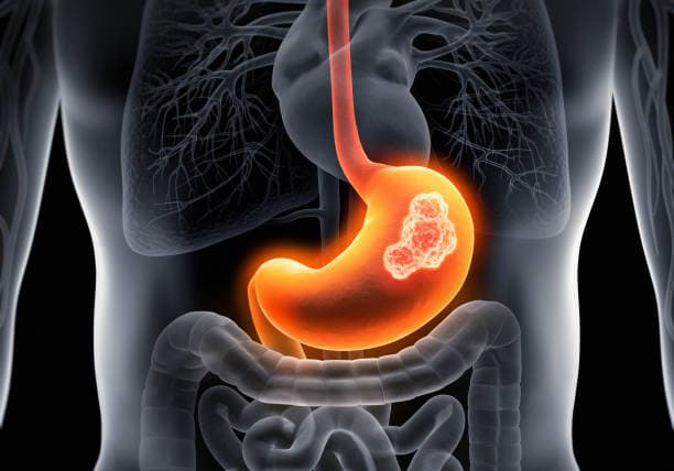 Illustration of early stomach cancer symptoms and digestive health
