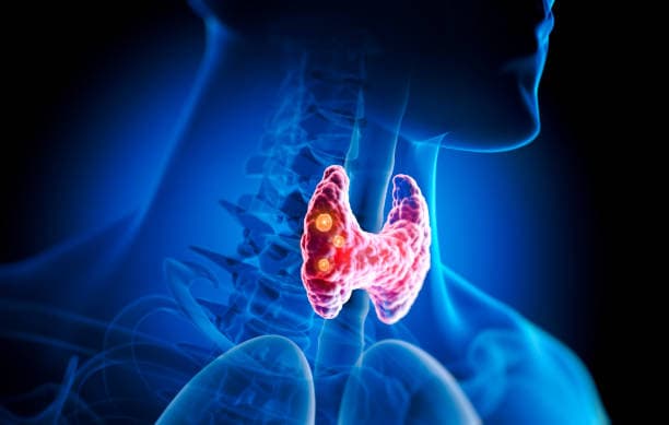 Image of thyroid symptoms and weight gain