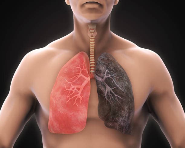 X-Ray of TB-Affected Lungs