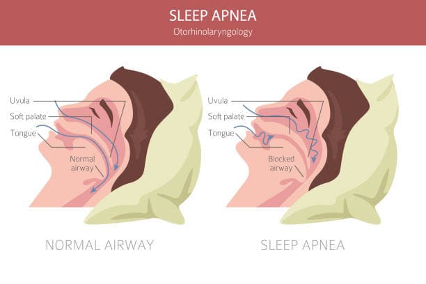 Sleep Apnea Health Impacts Visual