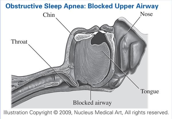 Obstructive Sleep Apnea Causes Diagram