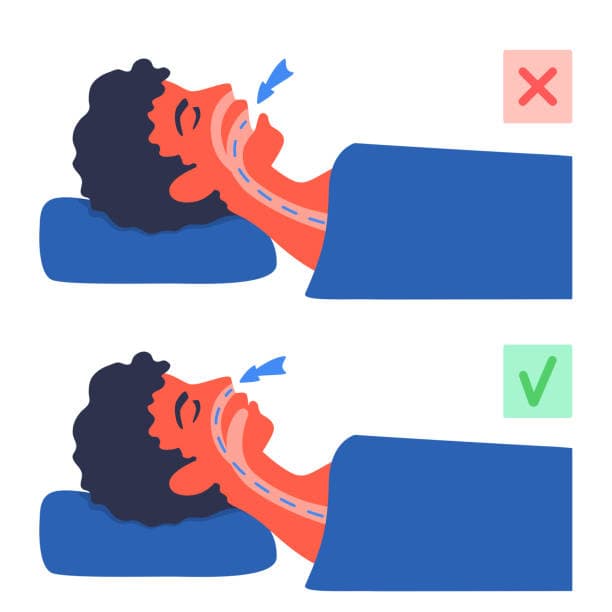 What Causes Sleep Apnea Overview
